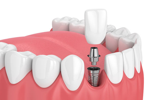 Kalathil Dental Clinic & Dental X -Ray Centre Mannarkkad